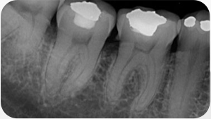 FOTO RX3 PERIAPICAL e1644264136497